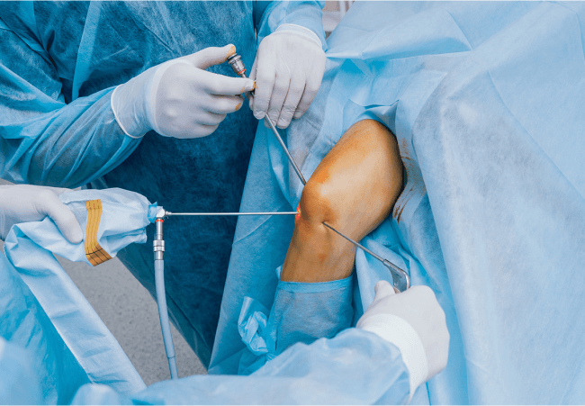 Keyhole knee arthroscopy, with the arthroscope and instruments entering the joint